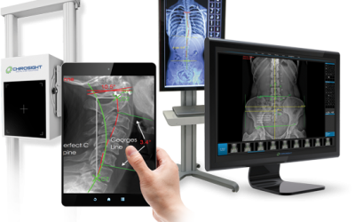 Why are digital x-rays better for the spine?
