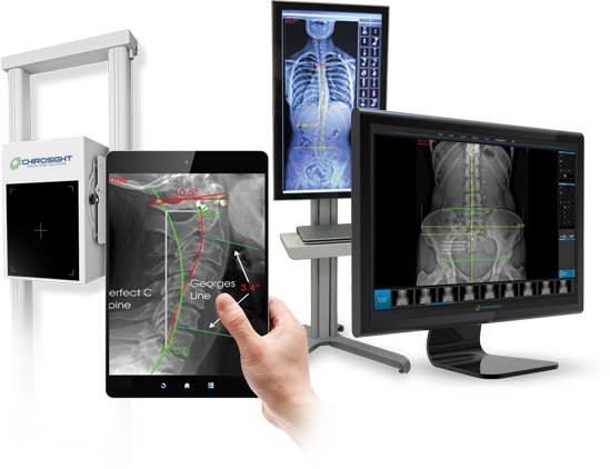 Why are digital x-rays better for the spine?
